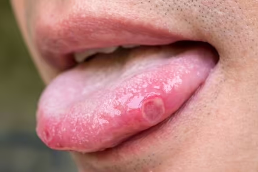 6 dấu hiệu dễ bị bỏ qua của ung thư miệng: Chuyên gia nhắc 2 đối tượng cần đặc biệt lưu ý - Ảnh 2.