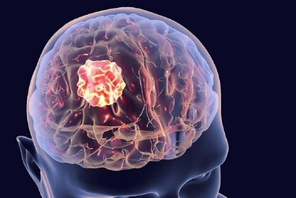 Từ đau đầu đến ung thư di căn não: Cần biết về triệu chứng và phương pháp điều trị - Ảnh 2.