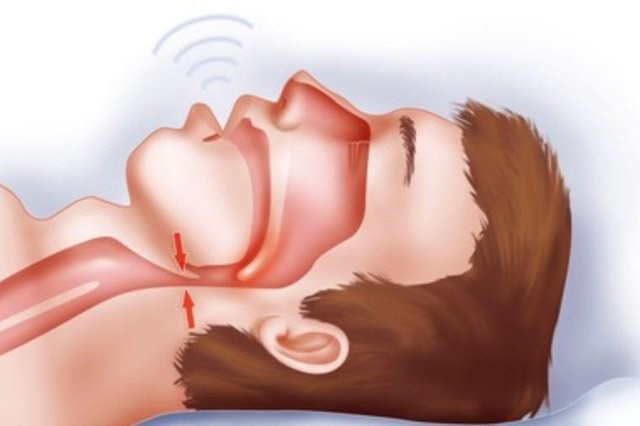 Bác sĩ tim mạch: Tiếng ngáy khi ngủ phản ánh tình trạng sức khỏe không thể bỏ qua - Ảnh 1.