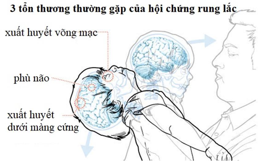 Bác sĩ: Có thể nghi ngờ trẻ bị bạo hành dựa vào sự kết hợp những dấu hiệu sau - Ảnh 3.