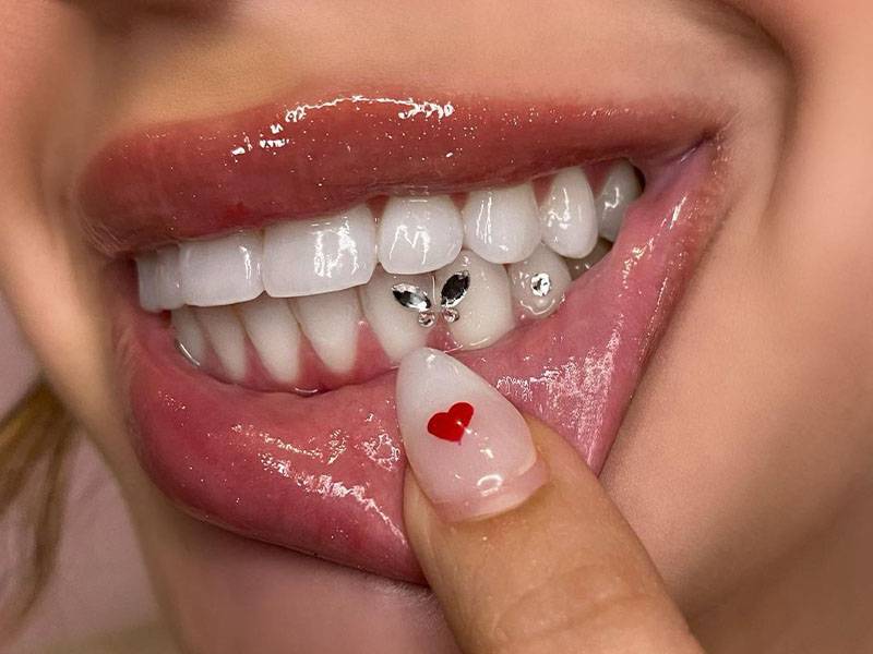 Xu hướng đính đá vào răng: Bác sĩ khuyến cáo điều quan trọng khi làm