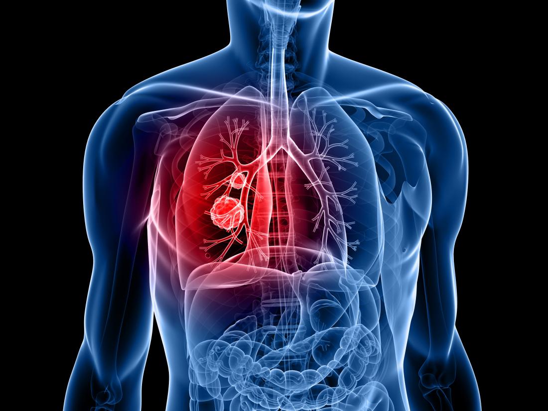 Nghiên cứu mới tiết lộ loại thực phẩm nhiều người ăn hàng ngày có thể giúp ngăn ngừa ung thư phổi - Ảnh 2.