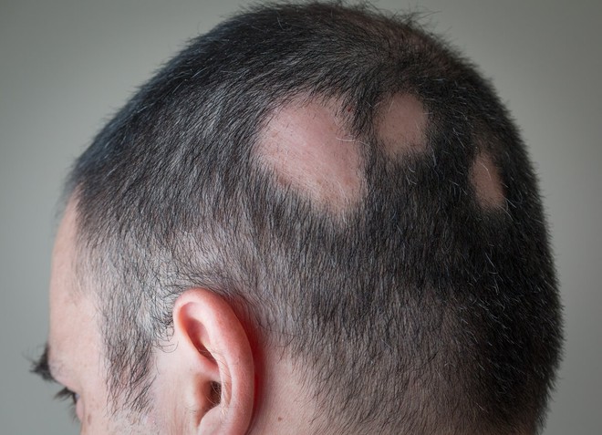 Thói quen thường gặp sau khi gội đầu lại là nguồn cơn khiến tóc gãy rụng, nấm bám trên da đầu - Ảnh 2.