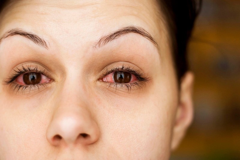 Bác sĩ chỉ ra nguyên nhân gây bệnh đau mắt đỏ ở người lớn và dấu hiệu cần đi khám ngay - Ảnh 1.