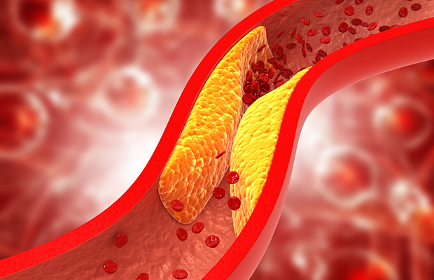 Khi cholesterol ‘xâm chiếm’ động mạch, chân có thể phát ra dấu hiệu này - Ảnh 1.