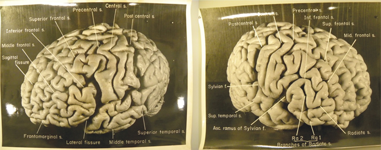 Mô tả phần vỏ não Albert Einstein trong nghiên cứu của Dean Falk năm 2013. Ảnh: BBC