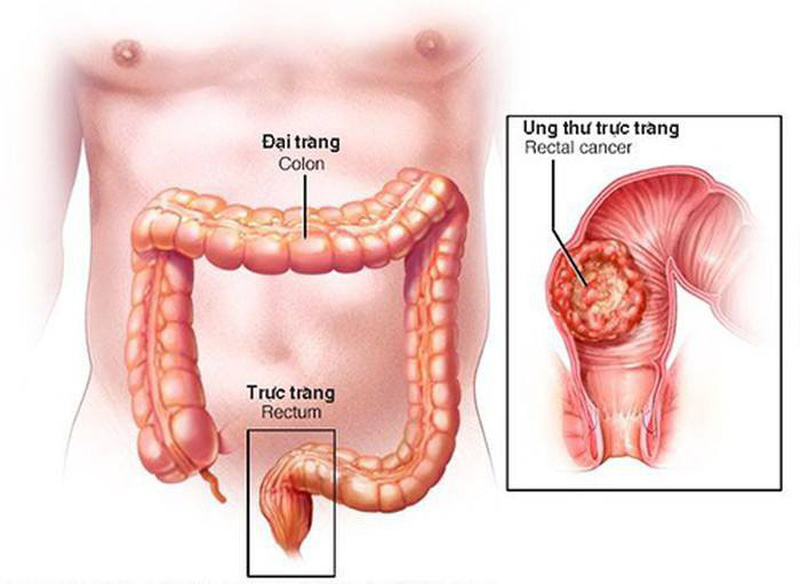 Chuyên gia dinh dưỡng ung thư tiết lộ 2 món ăn sáng giúp ngăn ngừa ung thư đại trực tràng- Ảnh 1.