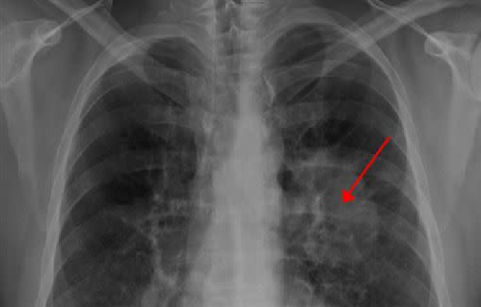 Người phụ nữ 37 tuổi qua đời sau 2 tuần phát hiện ung thư phổi, bác sĩ cảnh báo 1 dấu hiệu hầu hết mọi người đều bỏ qua- Ảnh 1.