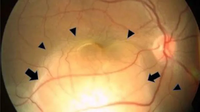Người phụ nữ phát hiện ung thư phổi ẩn giấu nhờ 1 dấu hiệu ở mắt- Ảnh 1.