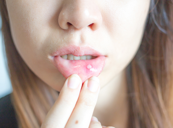3 bất thường ở khoang miệng là cảnh báo sớm khi tế bào ung thư tấn công cơ thể- Ảnh 2.