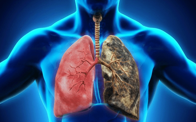 Tưởng chỉ cảm lạnh, người đàn ông bất ngờ nhận tin ung thư phổi: Triệu chứng cảnh báo hơn 1 tuần nhưng bị bỏ qua- Ảnh 2.