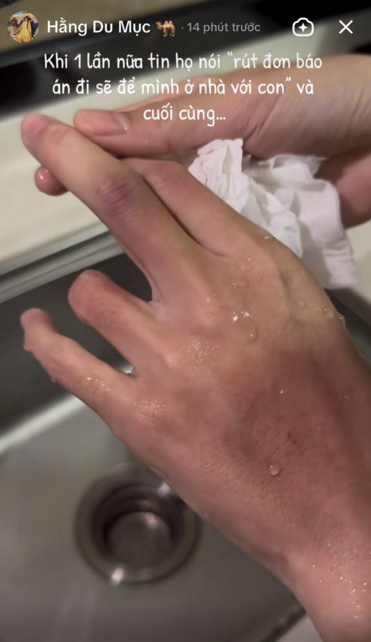 Hằng Du Mục chia sẻ về vết bầm trên cơ thể ẩn ý đây không phải lần đầu, chồng xác nhận xảy ra xô xát- Ảnh 3.