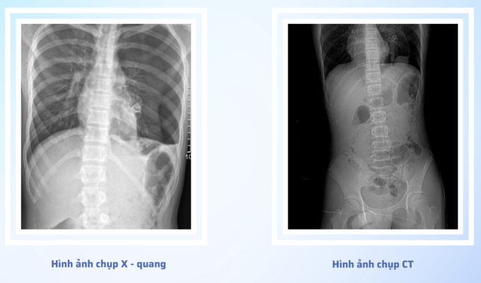 5 giờ phẫu thuật cho thiếu niên 15 tuổi bị cành cây đâm xuyên vùng hậu môn khi nhảy xuống ao tắm- Ảnh 1.