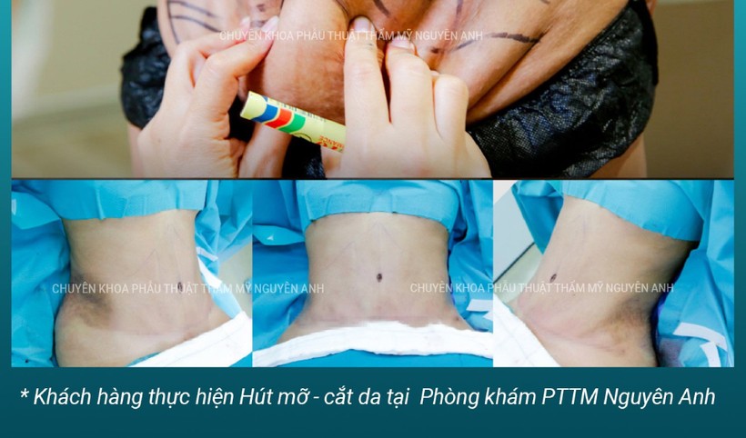 45 phút sau hút mỡ, một người phụ nữ nhồi máu não- Ảnh 1. 45 phút sau hút mỡ, một người phụ nữ nhồi máu não- Ảnh 1.