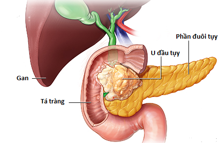 Chàng trai 29 tuổi bị đau lưng, BS nói chỉ còn sống được nửa năm, nguyên nhân do căn bệnh ung thư 