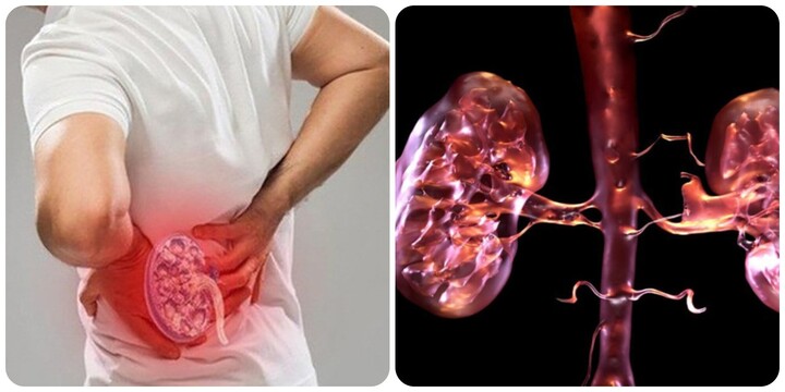 19 dấu hiệu thận yếu bạn không nên bỏ qua- Ảnh 1.