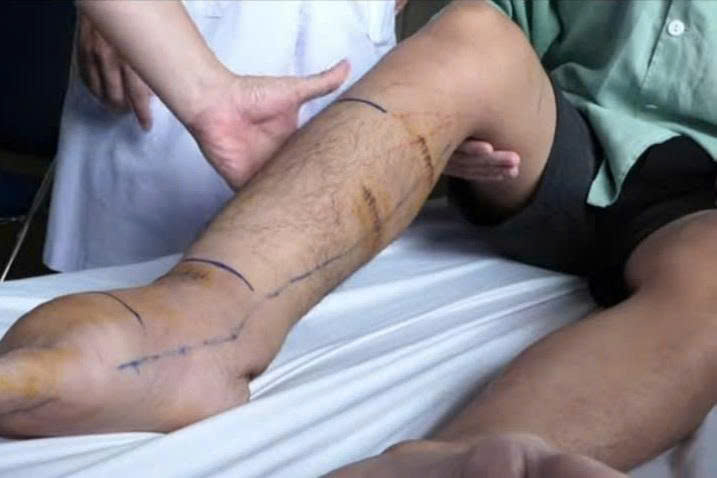 Chân to như "chân voi", nước tiểu trắng như sữa: Bác sĩ hé lộ 'thủ phạm' bất ngờ- Ảnh 1. Chân to như "chân voi", nước tiểu trắng như sữa: Bác sĩ hé lộ 'thủ phạm' bất ngờ- Ảnh 1.