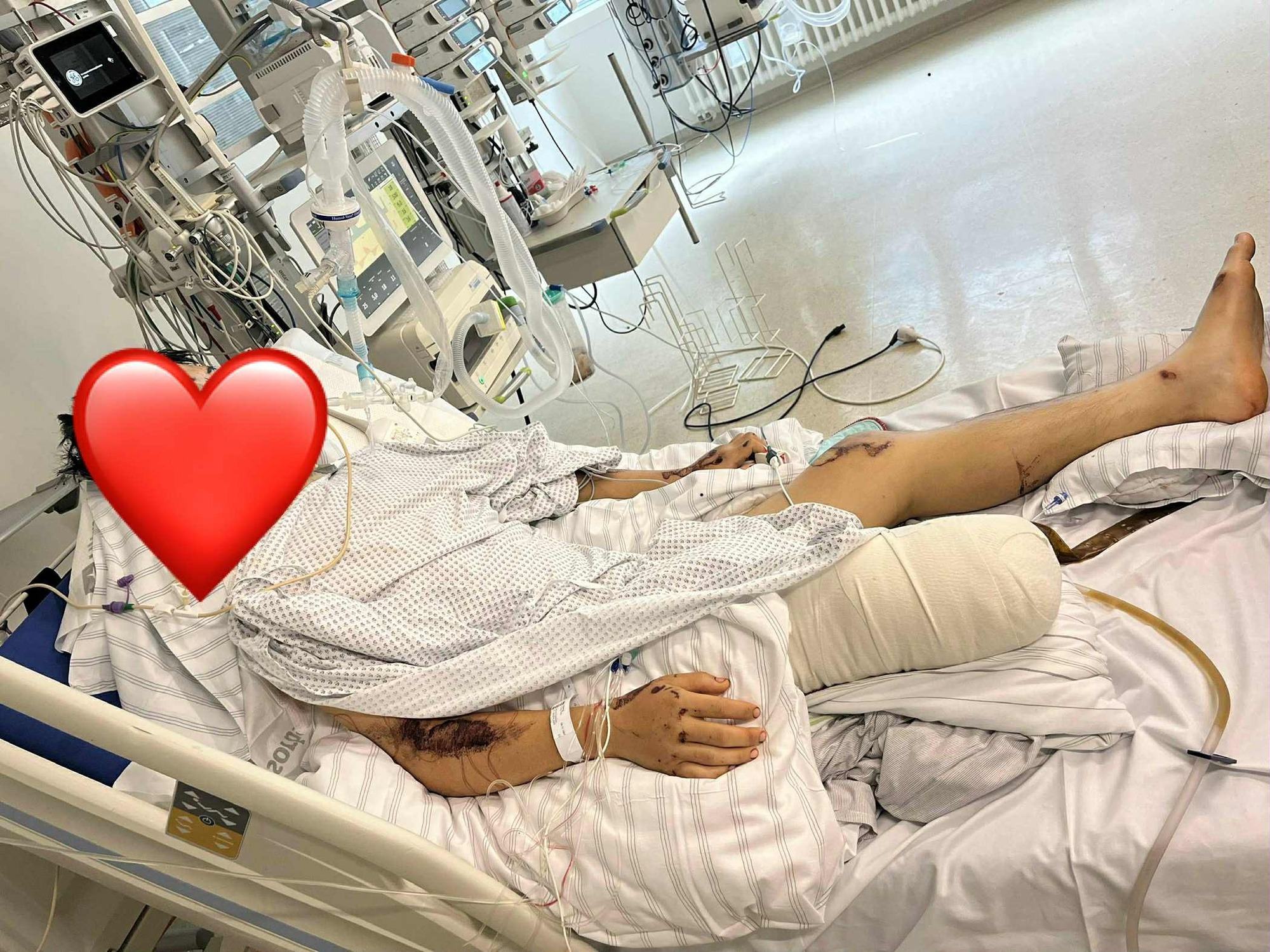 TikToker Bốp có chia sẻ đầu tiên sau tai nạn nghiêm trọng tại Đức, nhắc đến bạn gái với thái độ này- Ảnh 3. TikToker Bốp có chia sẻ đầu tiên sau tai nạn nghiêm trọng tại Đức, nhắc đến bạn gái với thái độ này- Ảnh 3.