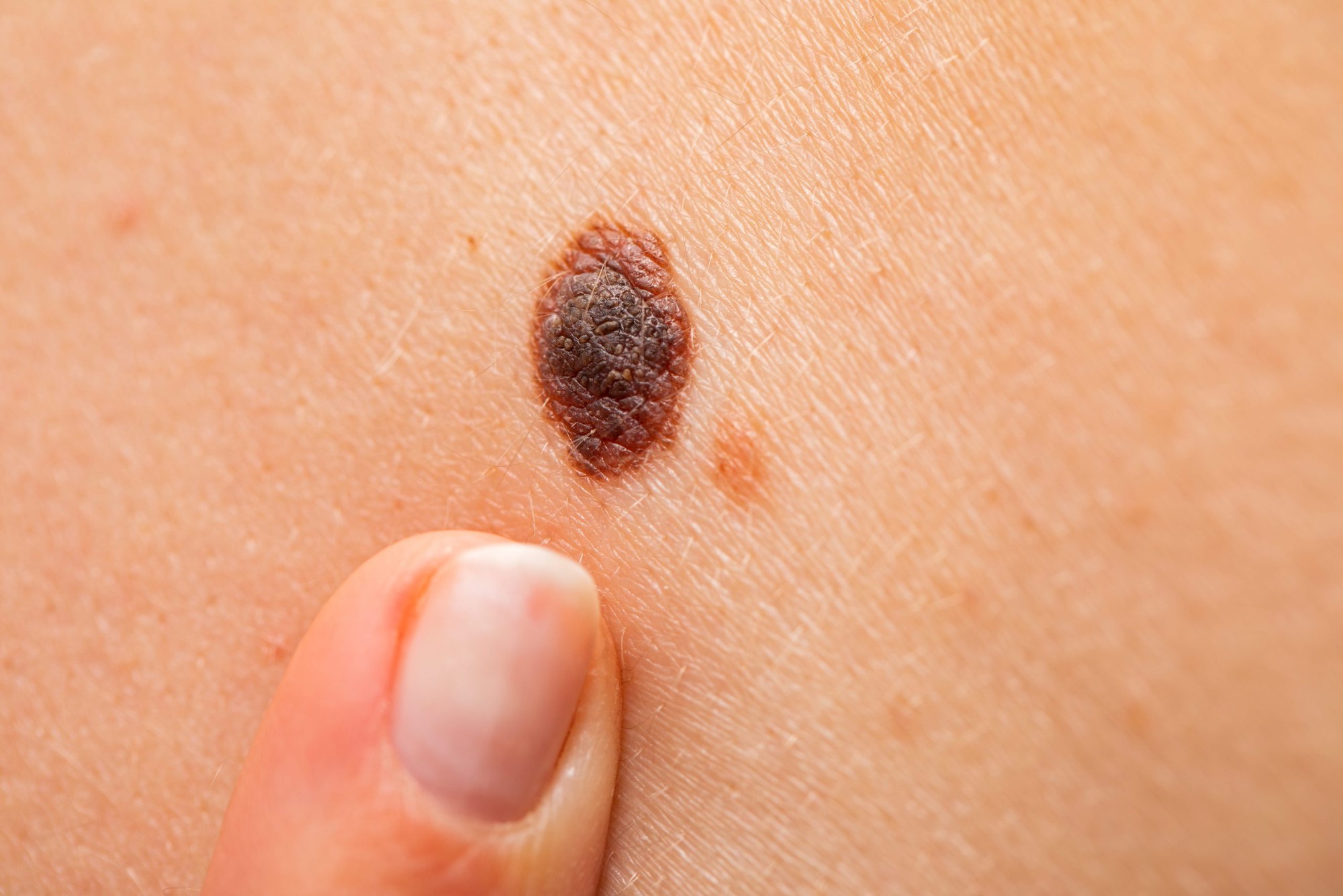 epi blog melanoma scaled epi blog melanoma scaled