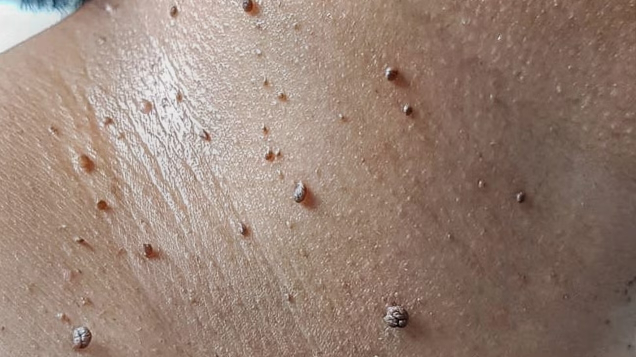 skin tags along the neck 1296x728 galleryslide2 skin tags along the neck 1296x728 galleryslide2