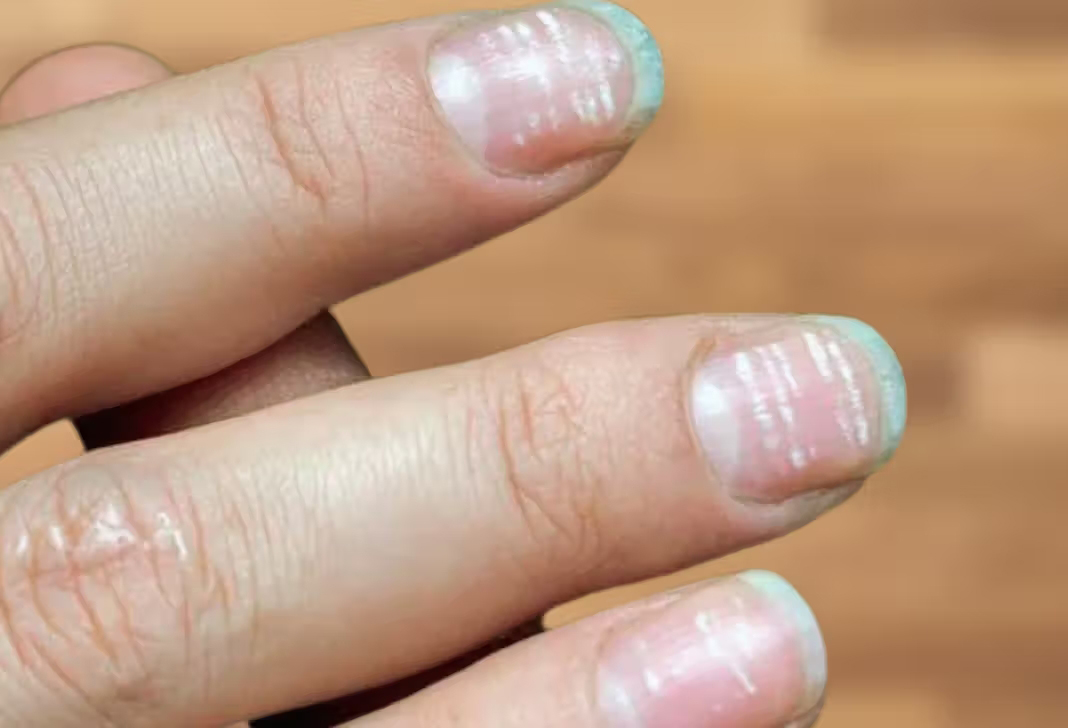 SOS với 5 dấu hiệu ung thư lộ rõ trên móng tay, nhiều người không hiểu vẫn "bình chân như vại"- Ảnh 2. SOS với 5 dấu hiệu ung thư lộ rõ trên móng tay, nhiều người không hiểu vẫn "bình chân như vại"- Ảnh 2.