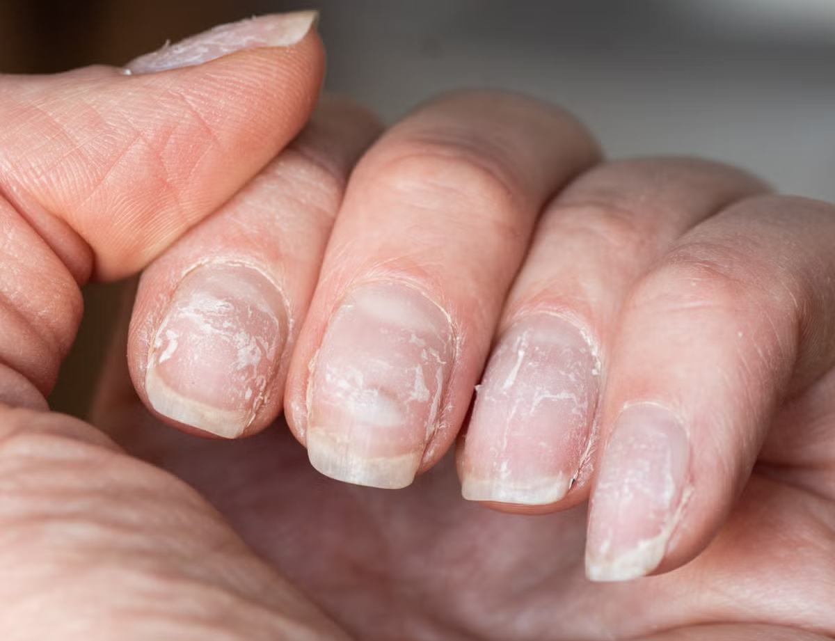 SOS với 5 dấu hiệu ung thư lộ rõ trên móng tay, nhiều người không hiểu vẫn "bình chân như vại"- Ảnh 3. SOS với 5 dấu hiệu ung thư lộ rõ trên móng tay, nhiều người không hiểu vẫn "bình chân như vại"- Ảnh 3.