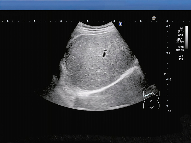 Nam sinh có gan trắng xoá, ngập trong mỡ: Bác sĩ nói thẳng “do 2 món khoái khẩu nhiều người mê”- Ảnh 1. Nam sinh có gan trắng xoá, ngập trong mỡ: Bác sĩ nói thẳng “do 2 món khoái khẩu nhiều người mê”- Ảnh 1.