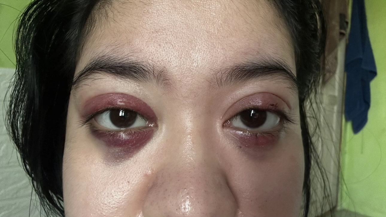 Phấn mắt PINKFLASH dính bê bối lớn: Người dùng bị lẹo mắt hàng loạt, hãng tiêu huỷ, đền tiền gấp đôi- Ảnh 5. Phấn mắt PINKFLASH dính bê bối lớn: Người dùng bị lẹo mắt hàng loạt, hãng tiêu huỷ, đền tiền gấp đôi- Ảnh 5.