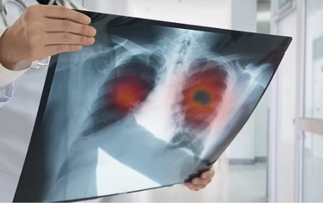 32 tuổi sống lành mạnh, sức khỏe tốt: Có 1 triệu chứng kéo dài 2 tuần, đi khám bỗng nhận kết quả K phổi- Ảnh 1. 32 tuổi sống lành mạnh, sức khỏe tốt: Có 1 triệu chứng kéo dài 2 tuần, đi khám bỗng nhận kết quả K phổi- Ảnh 1.