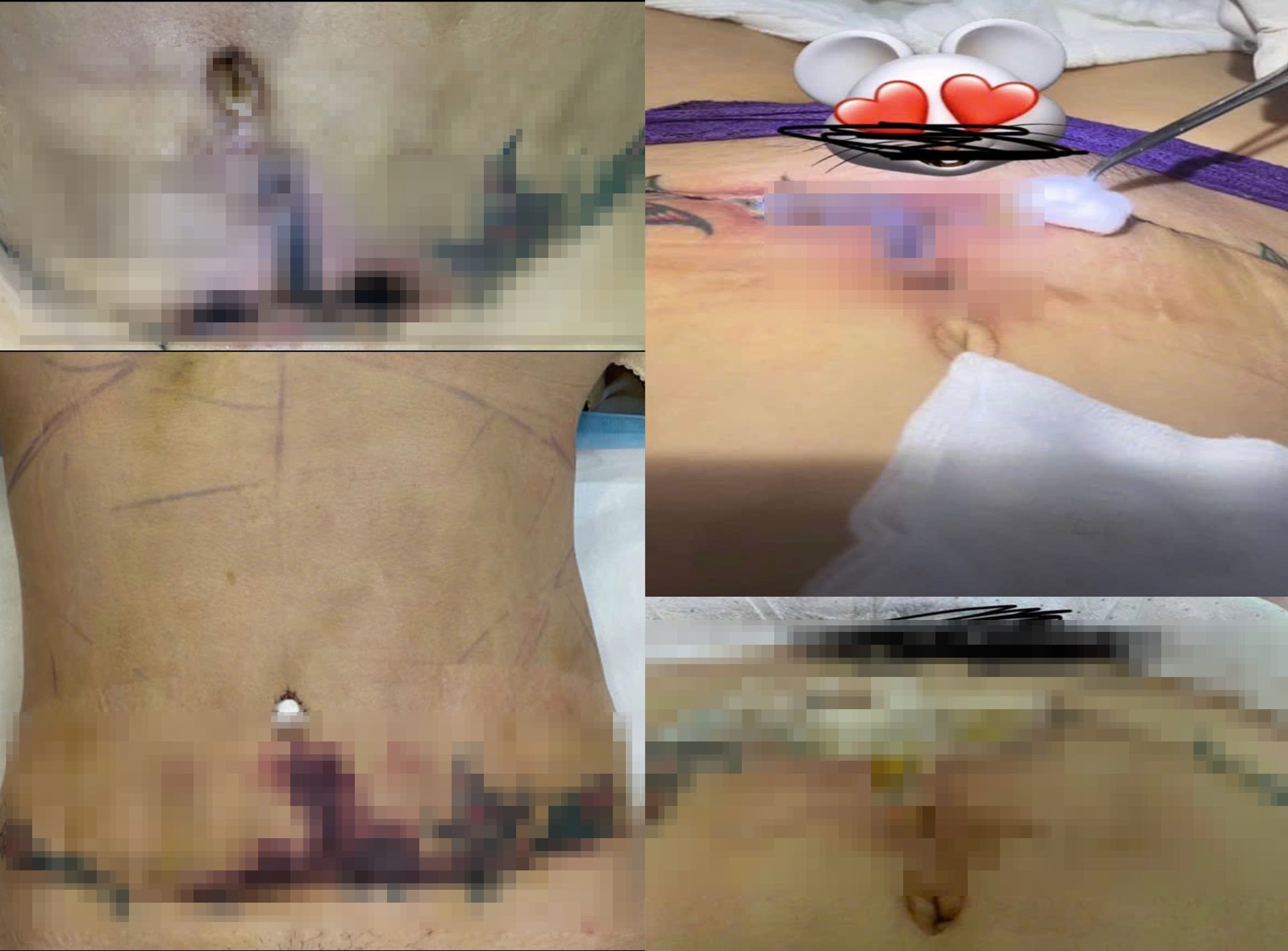 Sau điều tra Góc khuất "công nghệ" thẩm mỹ: Thêm một nữ nạn nhân tố Bệnh viện Thẩm mỹ JT Angel- Ảnh 2. Sau điều tra Góc khuất "công nghệ" thẩm mỹ: Thêm một nữ nạn nhân tố Bệnh viện Thẩm mỹ JT Angel- Ảnh 2.