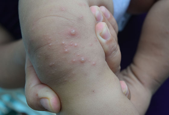 TP.HCM ghi nhận 1.481 ca mắc căn bệnh này trong 1 tuần: Bác sĩ chỉ ra 2 việc cần làm ngay để phòng ngừa- Ảnh 1.