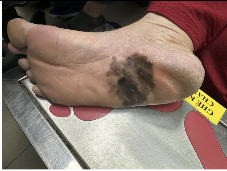 Đốm đen trên da có phải là dấu hiệu ung thư da?- Ảnh 2. Đốm đen trên da có phải là dấu hiệu ung thư da?- Ảnh 2.