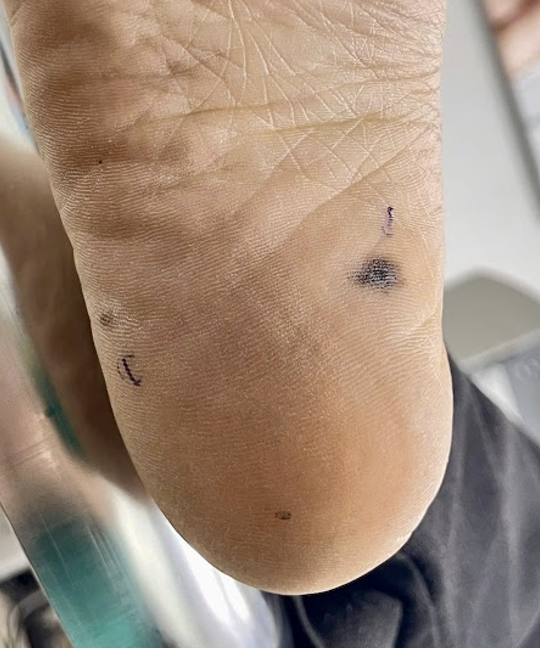 Đốm đen trên da có phải là dấu hiệu ung thư da?- Ảnh 3. Đốm đen trên da có phải là dấu hiệu ung thư da?- Ảnh 3.