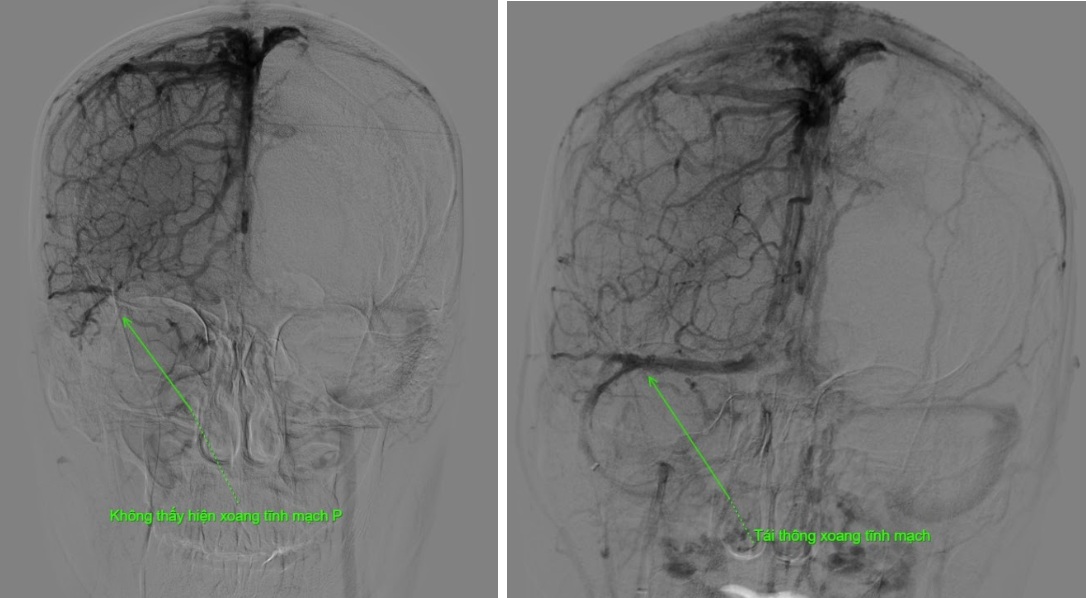 Thanh niên Phú Thọ nhập viện với tình trạng đau đầu dữ dội, bác sĩ khẳng định: Trường hợp hiếm gặp, có nguy cơ tổn thương não nếu không xử lý kịp- Ảnh 1.