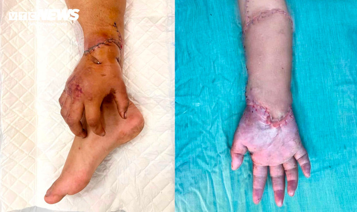 Bàn tay đứt lìa của mẹ bầu được nối lại sau thời gian 'nuôi' ở chân- Ảnh 1.