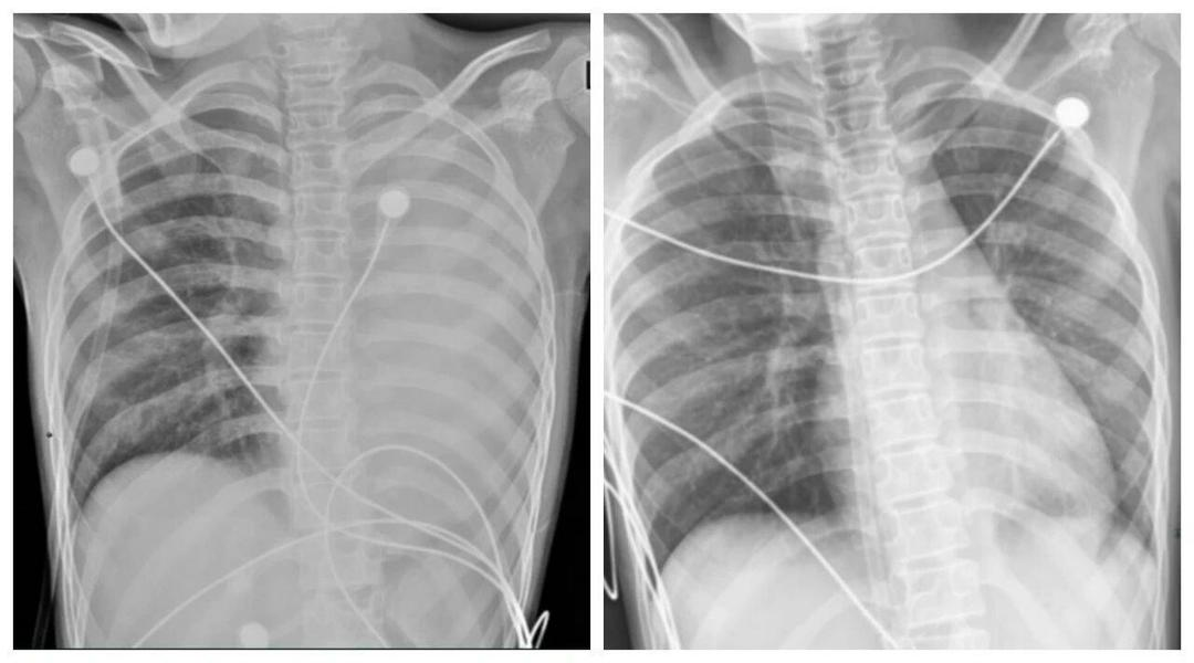Bé trai 12 tuổi "phổi trắng xóa” chỉ sau 1 ngày mắc cúm: Cách phát hiện sớm cúm nặng ở trẻ- Ảnh 1.