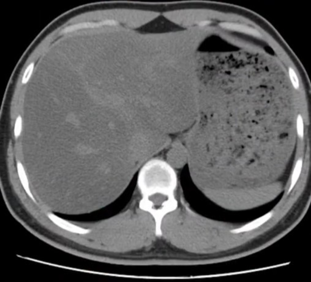 Nữ kế toán bị gan nhiễm mỡ nặng vì ăn loại rau này luộc suốt 6 tháng để giảm cân- Ảnh 2.