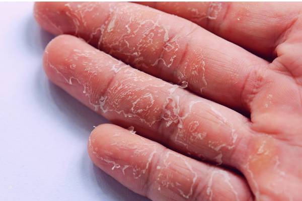 Khổ cả mùa đông vì da tay da chân bong tróc: Thói quen nhiều người vẫn làm mà không nhận ra đang tự làm đau mình- Ảnh 1.