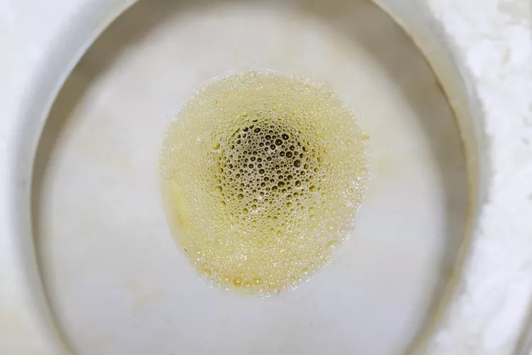 Tại sao ung thư thận thường phát hiện muộn? Đã có quá nhiều người bỏ lỡ “2 nhiều, 1 ít” này ở giai đoạn sớm! - Ảnh 2.