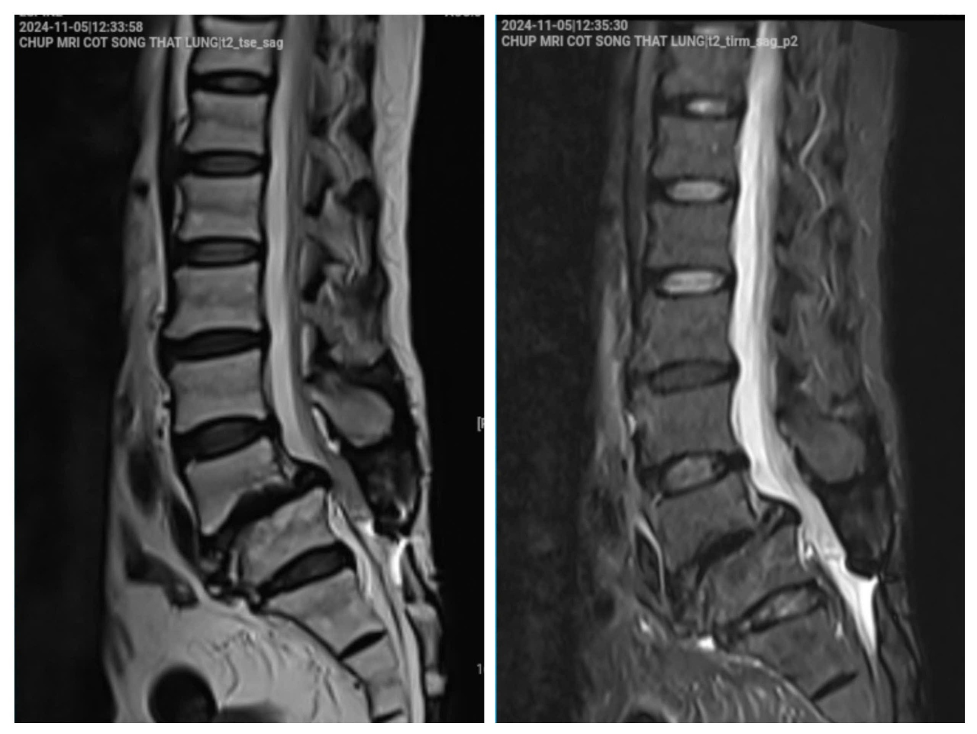 Người phụ nữ suýt liệt vì tập yoga chữa thoát vị đĩa đệm- Ảnh 1.