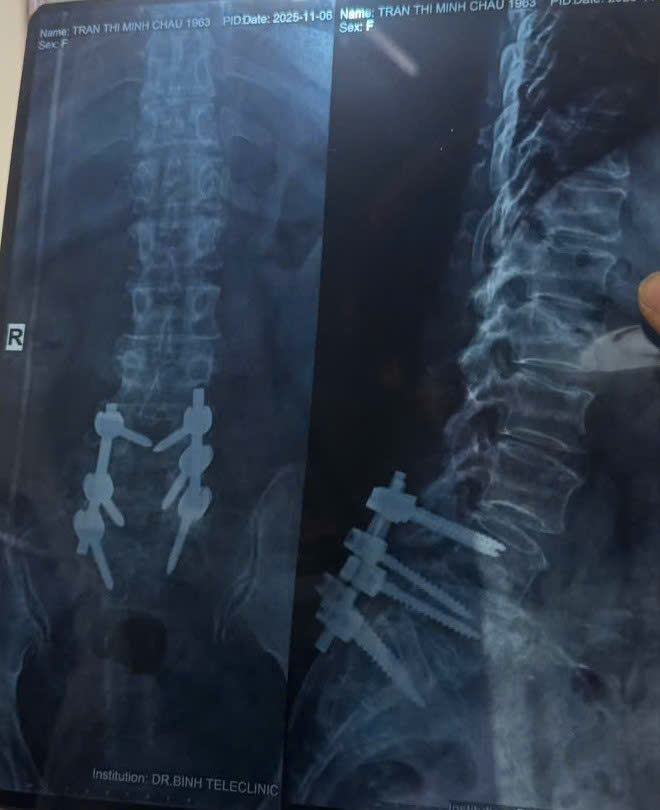 Người phụ nữ suýt liệt vì tập yoga chữa thoát vị đĩa đệm- Ảnh 4.