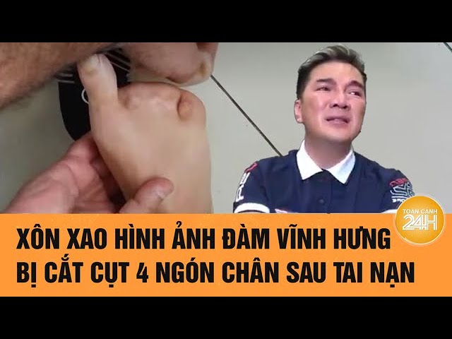 Ca sĩ Đàm Vĩnh Hưng phải cắt cụt 4 ngón chân là thật- Ảnh 2.