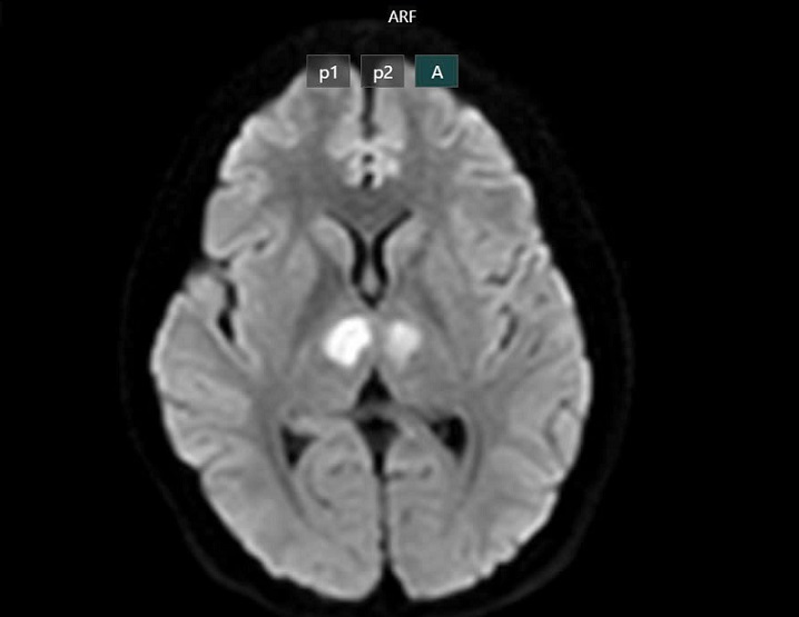Hà Nội: Cô gái 21 tuổi bất tỉnh, tổn thương não nặng vì dùng thuốc “7 ngày giảm 7kg” mua trên Tiktok- Ảnh 1.