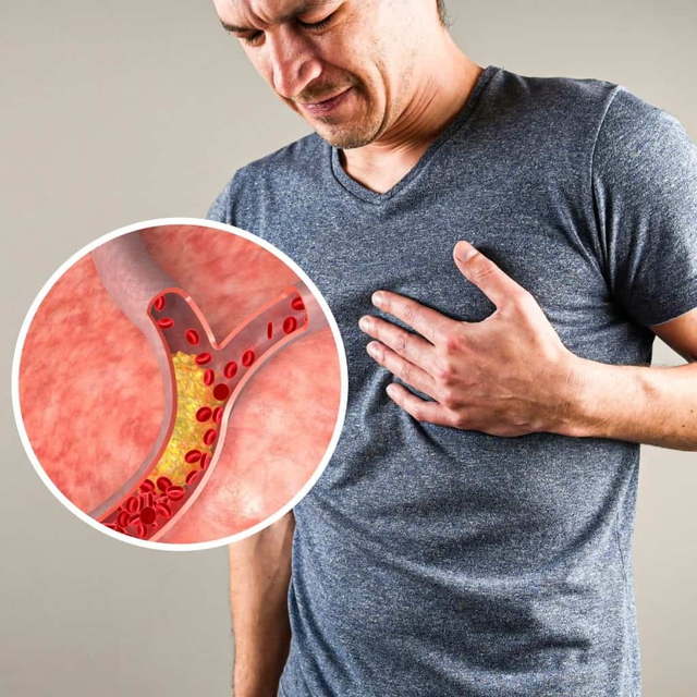 Chàng trai 26 tuổi đột quỵ, máu nhiễm mỡ nghiêm trọng: Ngày nào cũng ăn 2 món nhiều người Việt mê- Ảnh 2. Chàng trai 26 tuổi đột quỵ, máu nhiễm mỡ nghiêm trọng: Ngày nào cũng ăn 2 món nhiều người Việt mê- Ảnh 2.