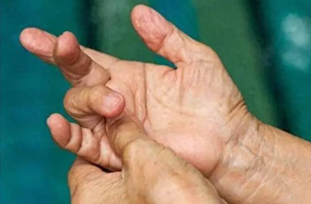 4 thay đổi ở ngón tay có thể là dấu hiệu ung thư phổi, hãy đi khám ngay!- Ảnh 6. 4 thay đổi ở ngón tay có thể là dấu hiệu ung thư phổi, hãy đi khám ngay!- Ảnh 6.
