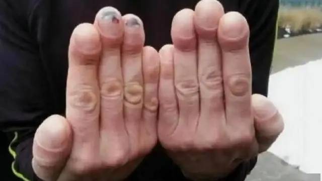 4 thay đổi ở ngón tay có thể là dấu hiệu ung thư phổi, hãy đi khám ngay!- Ảnh 2. 4 thay đổi ở ngón tay có thể là dấu hiệu ung thư phổi, hãy đi khám ngay!- Ảnh 2.