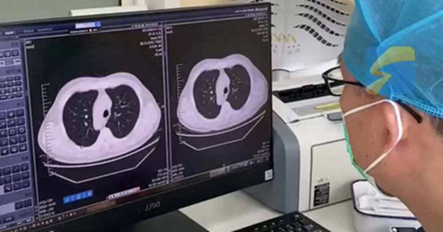 Cảm lạnh và ho, phổi trái của nam sinh đột nhiên "biến mất": Bác sĩ tiết lộ nguyên nhân nhiều người phải cẩn thận- Ảnh 1. Cảm lạnh và ho, phổi trái của nam sinh đột nhiên "biến mất": Bác sĩ tiết lộ nguyên nhân nhiều người phải cẩn thận- Ảnh 1.
