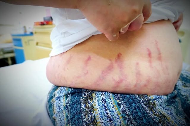 "Con tôi chỉ bị viêm mũi dị ứng thôi mà...": Người mẹ khóc nấc vì không ngờ thói quen xịt mũi lại khiến con bị suy tuyến thượng thận- Ảnh 2. "Con tôi chỉ bị viêm mũi dị ứng thôi mà...": Người mẹ khóc nấc vì không ngờ thói quen xịt mũi lại khiến con bị suy tuyến thượng thận- Ảnh 2.