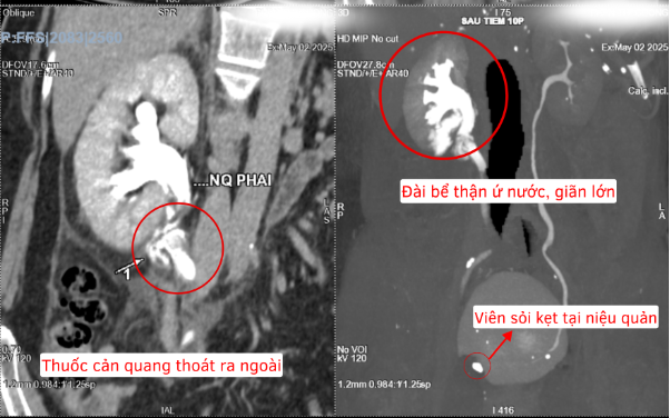 Kịp thời cứu bệnh nhân có sỏi kẹt niệu quản gây đa biến chứng- Ảnh 1. Kịp thời cứu bệnh nhân có sỏi kẹt niệu quản gây đa biến chứng- Ảnh 1.