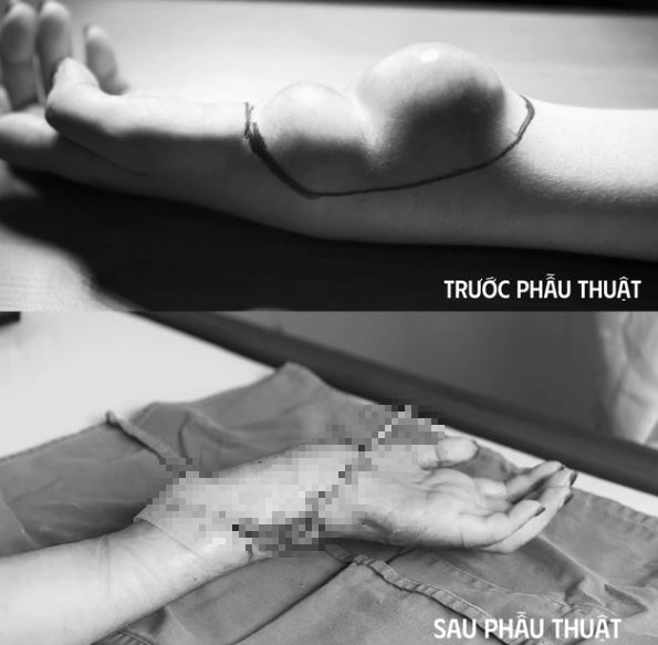 Đau tay suốt 9 năm, cô gái 23 tuổi bất ngờ phát hiện mắc ung thư- Ảnh 1. Đau tay suốt 9 năm, cô gái 23 tuổi bất ngờ phát hiện mắc ung thư- Ảnh 1.
